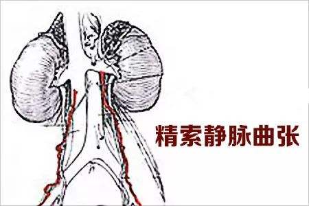 什么是精索静脉曲张?