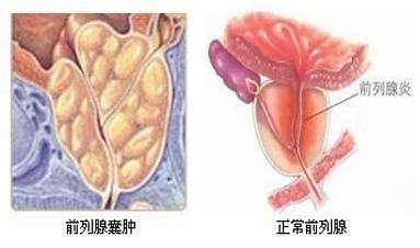 前列腺囊肿的危害,前列腺囊肿需要治疗吗