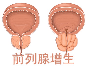 南乐前列腺增生肥大怎么治疗